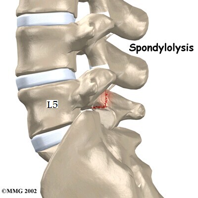 Spondylolysis.jpg