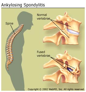 arthritis_ankylosing_spondylitis_ankylosing_spondylitis.jpg