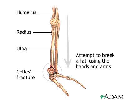 colles-fracture.jpg