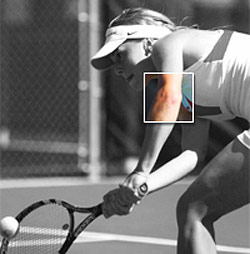 tennis-elbow.jpg