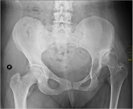 Hip dislocation image