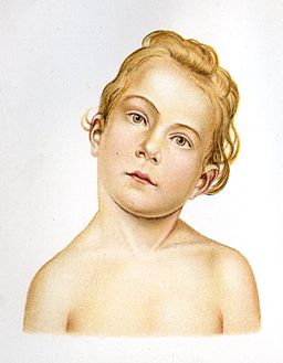 Torticollis.jpg