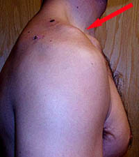 shoulder_separation_clinical_photo_lateral-2.jpg