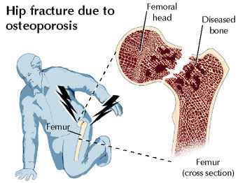 Corticosteroid use and osteoporosis