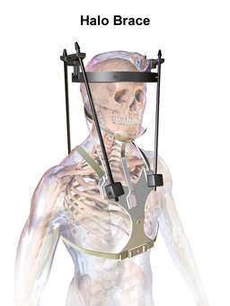 Image of Skeleton in Halo Vest Orthoses for Cervical stabilization