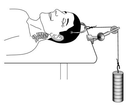 Image of man with cervical traction applied through halo pins