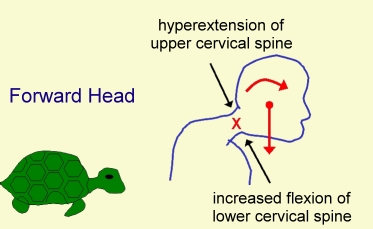 ForwardHead.jpg