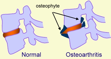 CervicalOA.jpg