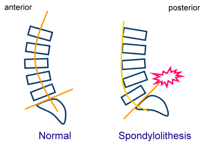 SpondylolithesisLat.png