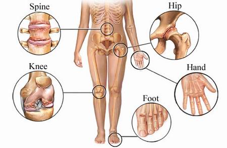 osteoarthritis2.jpg