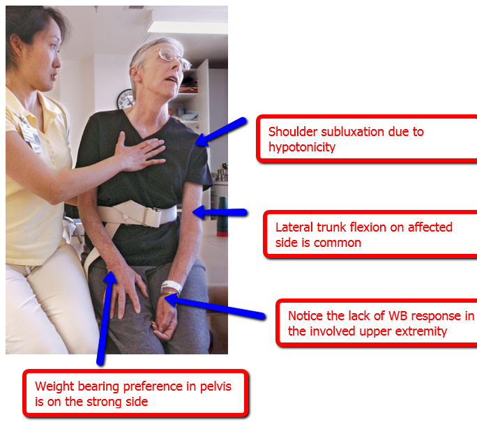 pnf exercises for stroke patients