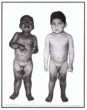 01kwashiorkor